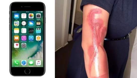iPhone 7 yüzünden kolu yandı!