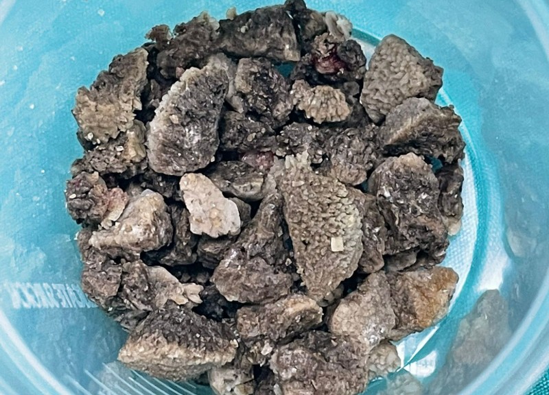 8 Santimetrelik Dev Böbrek Taşı Malatya’da Kapalı Yöntemle Başarıyla Çıkarıldı